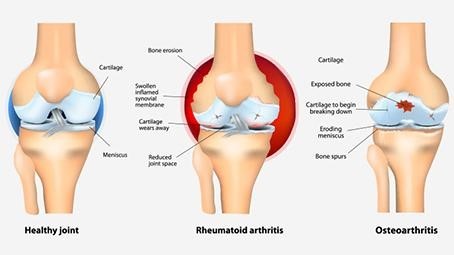 Joint Pains