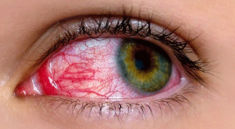 Pink Eye: Nearly 100,000 Cases in Punjab Raise Concerns