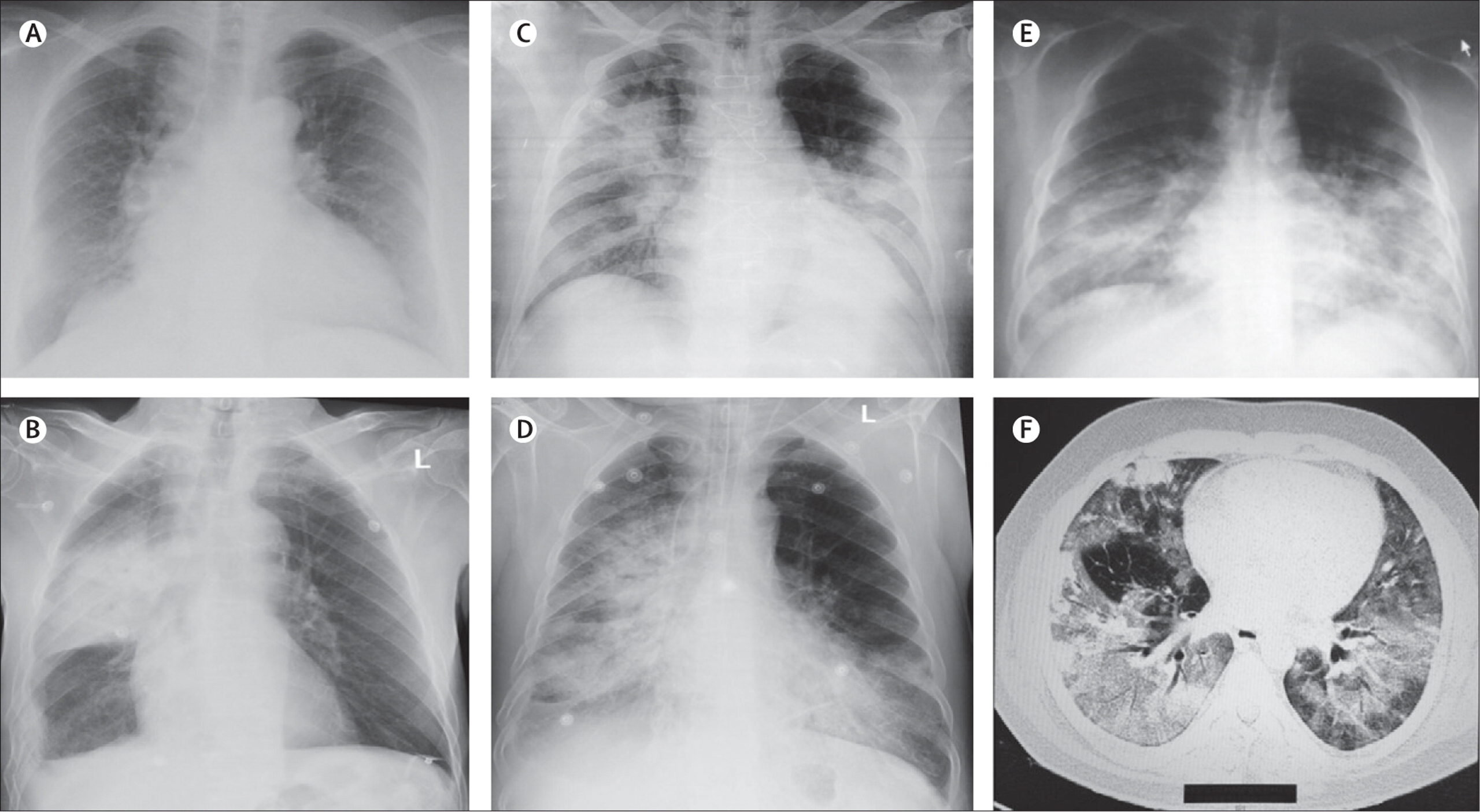 disturbing-spread-of-the-mysterious-lung-disease-with-white-spots