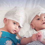 Pakistani Conjoined Twins Separated in Groundbreaking Surgery