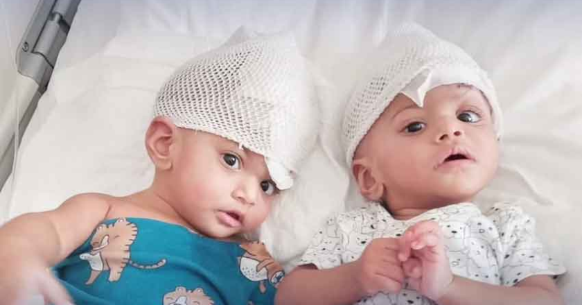 Pakistani Conjoined Twins Separated in Groundbreaking Surgery